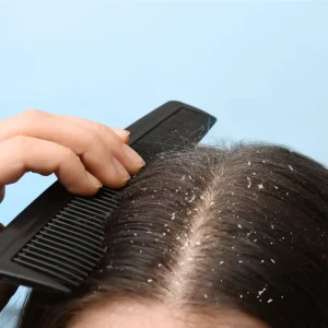 Read more about the article What Causes Dandruff?